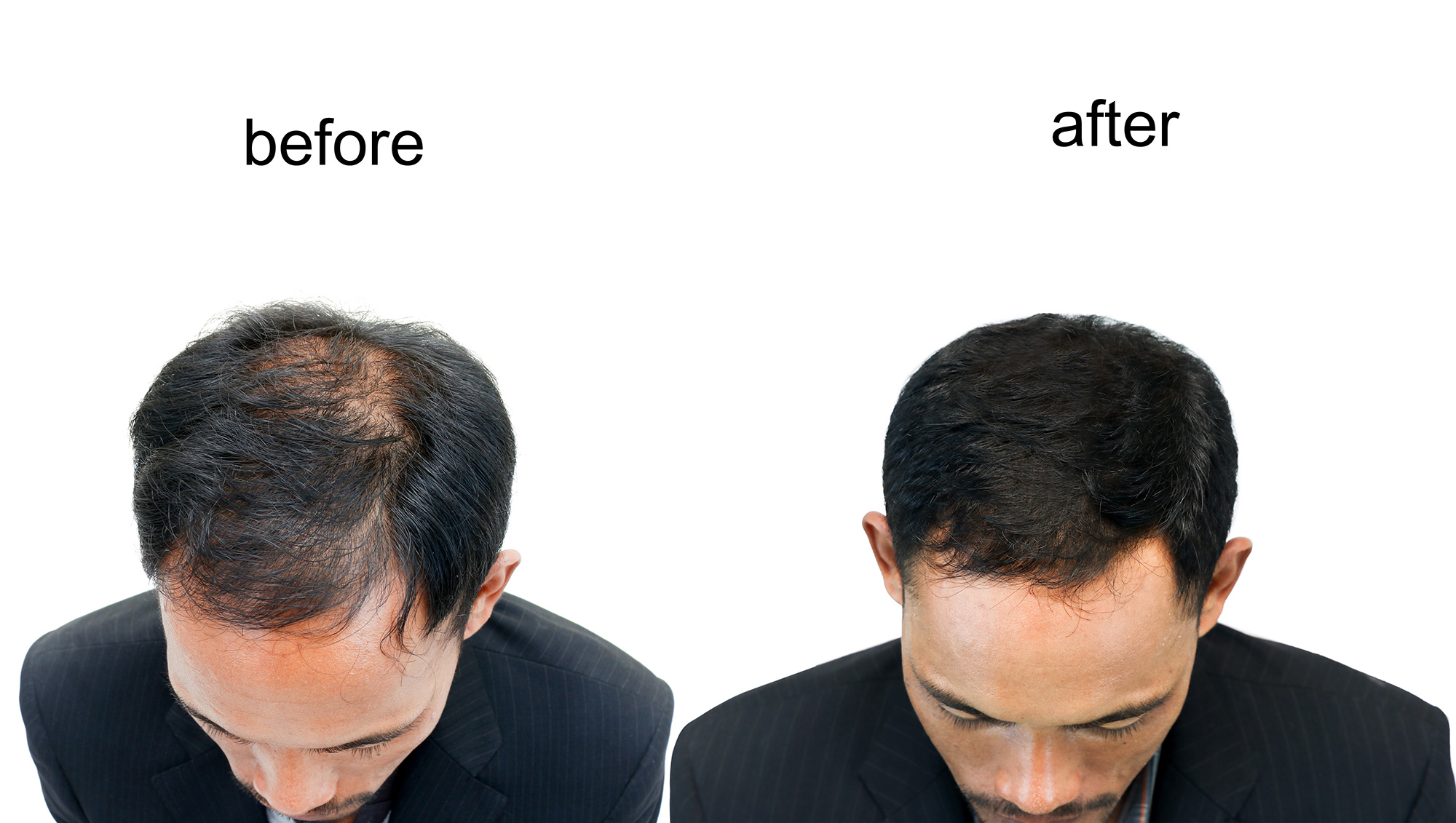 Toronto Hair Restoration Treatments with PRP | platelet rich plasma  injection