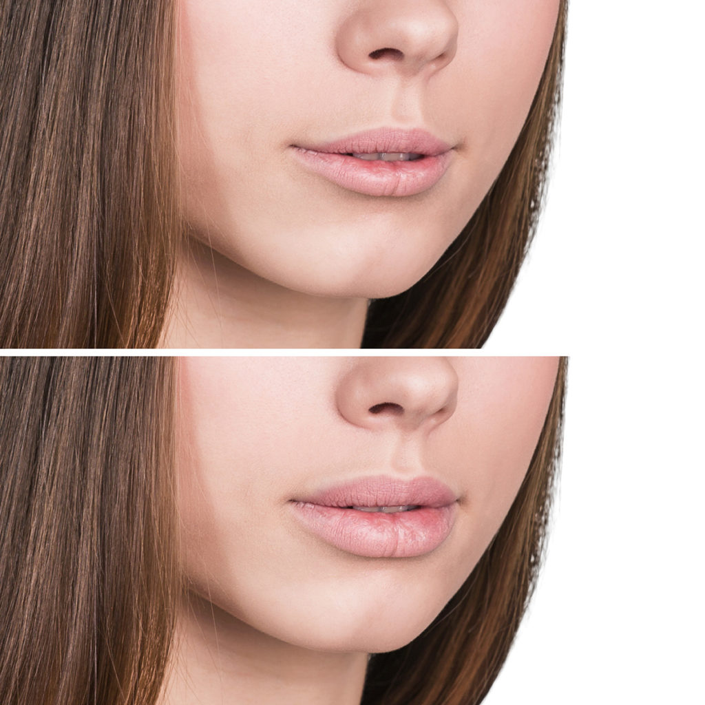 Lips Augmentation Toronto Lips Enhancement NonSurgical Treatments