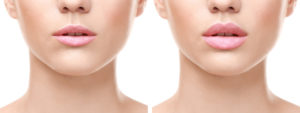 Lips-Augmentation-derma-fillers