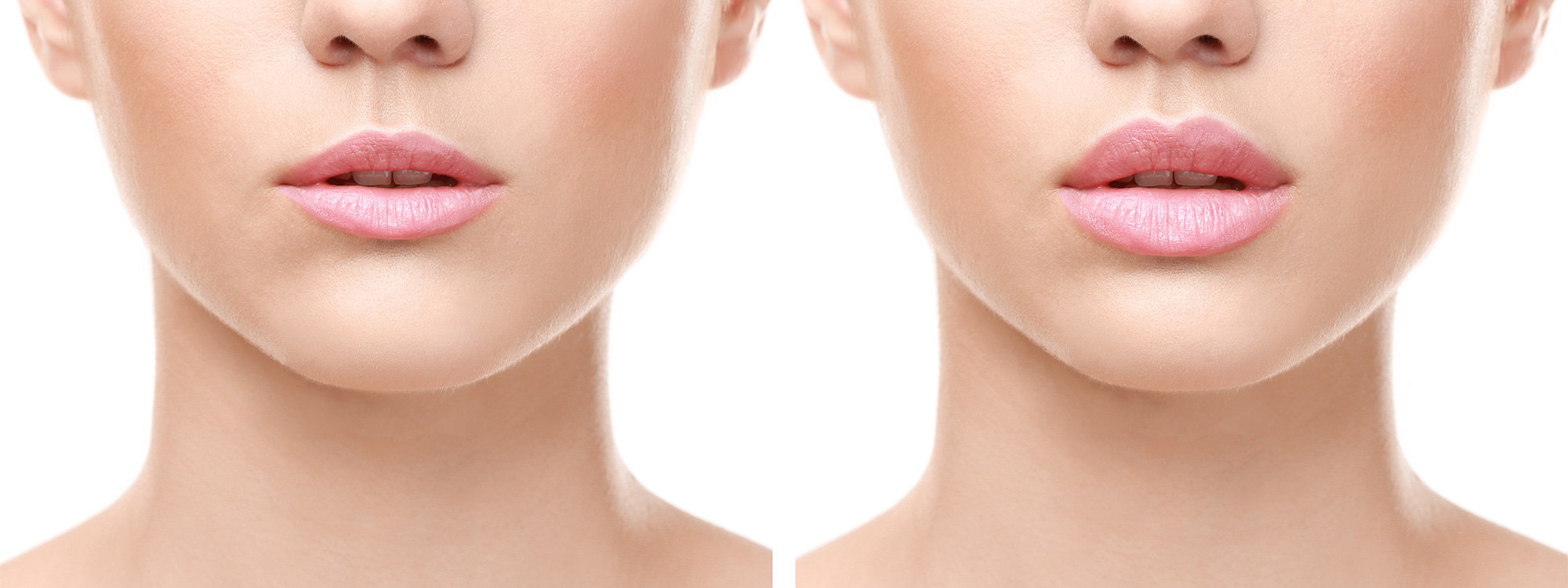 Lips-Augmentation-Experts-in-Toronto