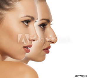 Nose Correction-1