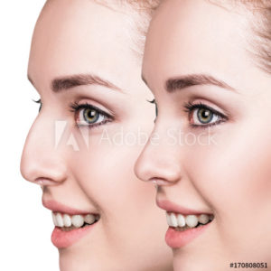 Nose Correction-2