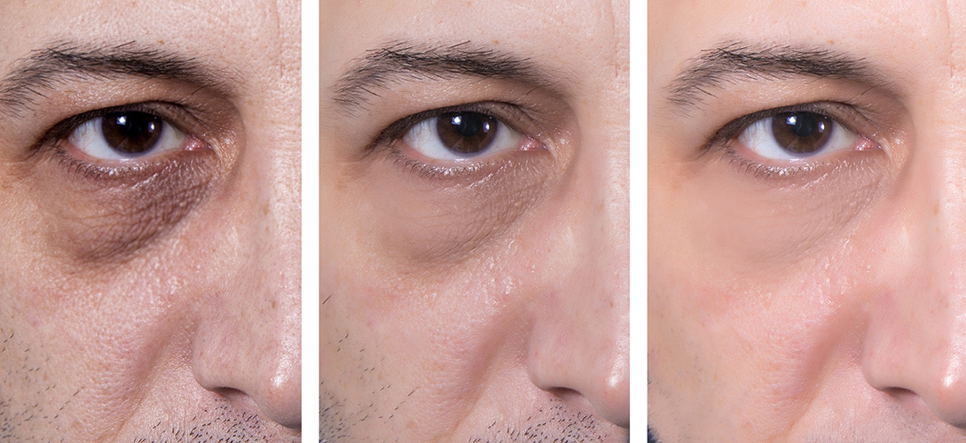 Remove wrinkles on chin ( Derma Filler for men )