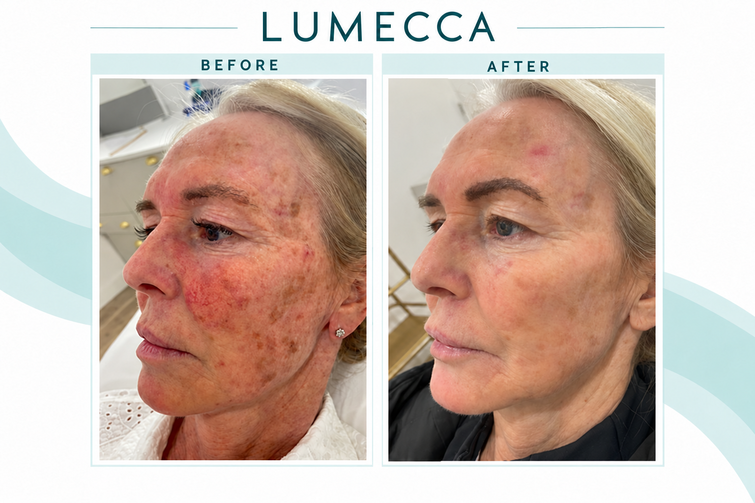 /belkyra-kybella/